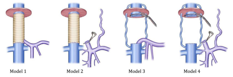 Resecting the Unresectable – Advances in Extracorporeal Liver Surgery (ELS)
